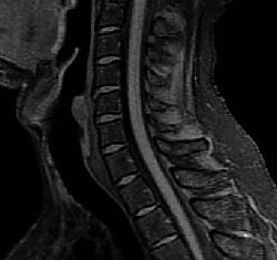 頸部MRI画像