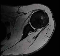 肩関節MRI画像