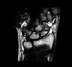 筋挫傷MRI画像