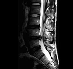 腰椎MRI画像